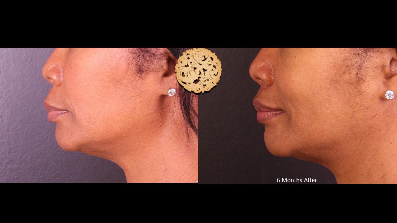 Lip Lift Before & After