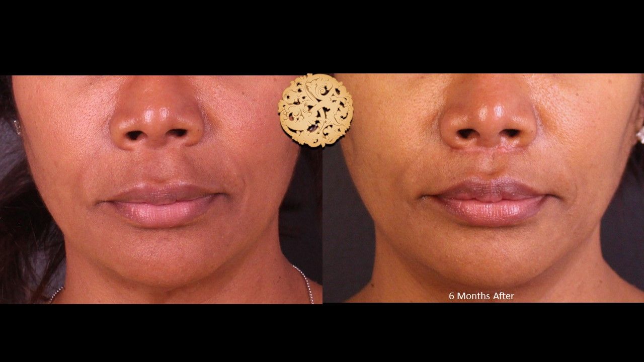 Lip Lift Before & After