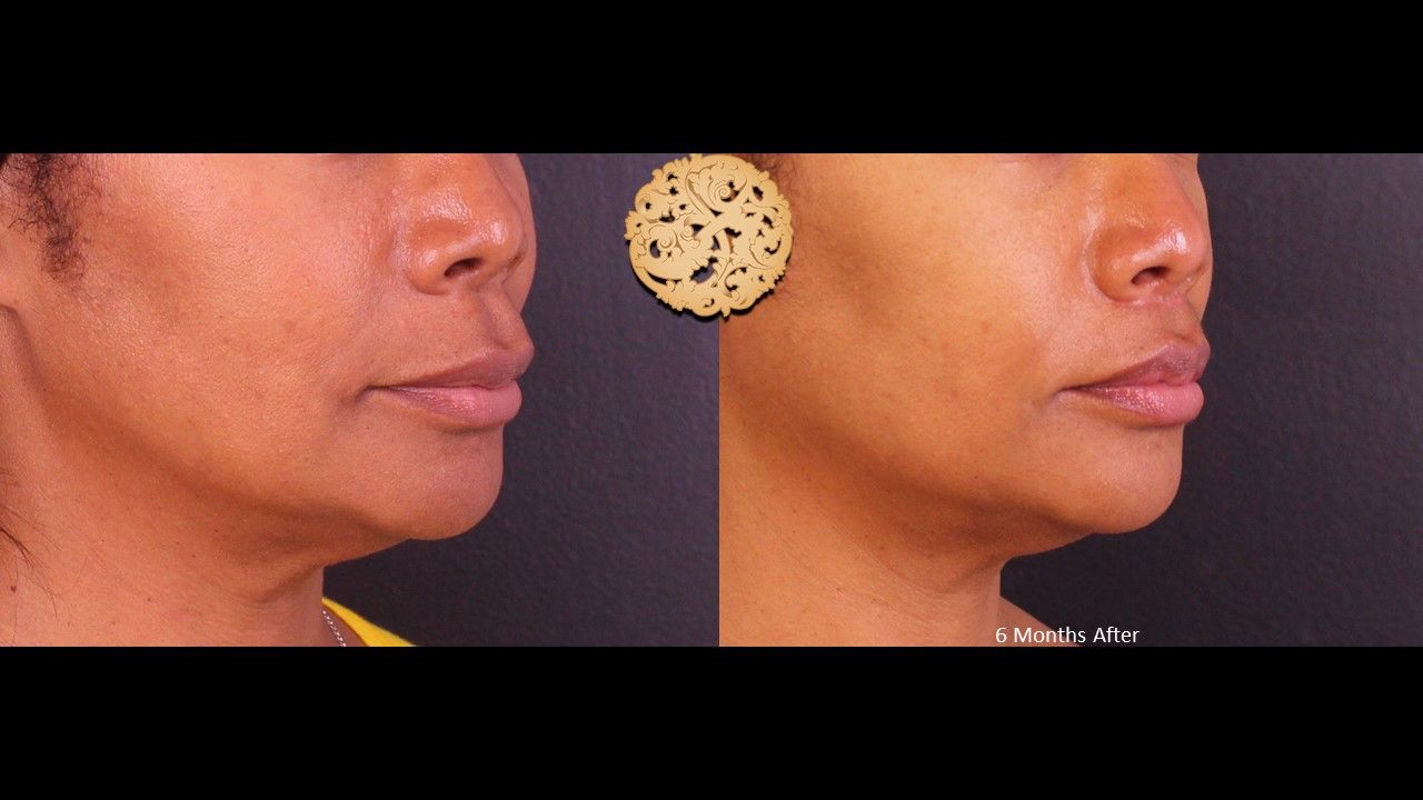 Lip Lift Before & After