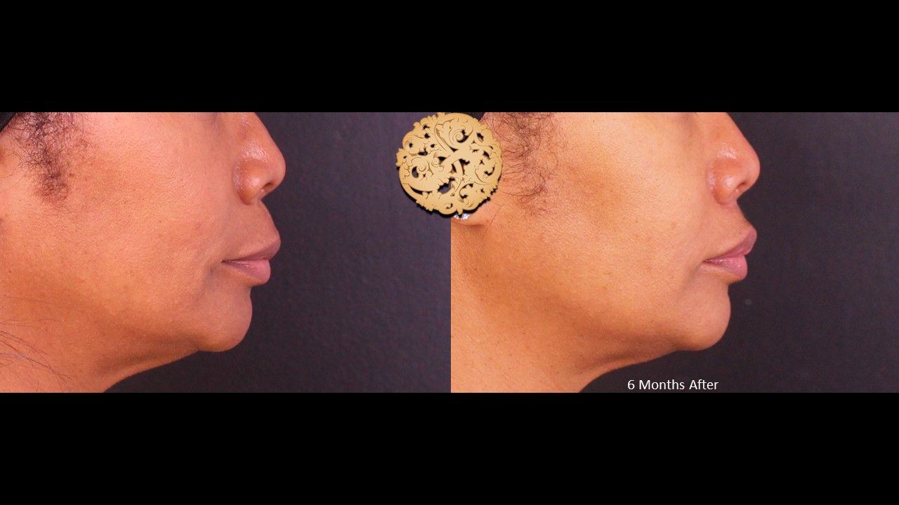 Lip Lift Before & After