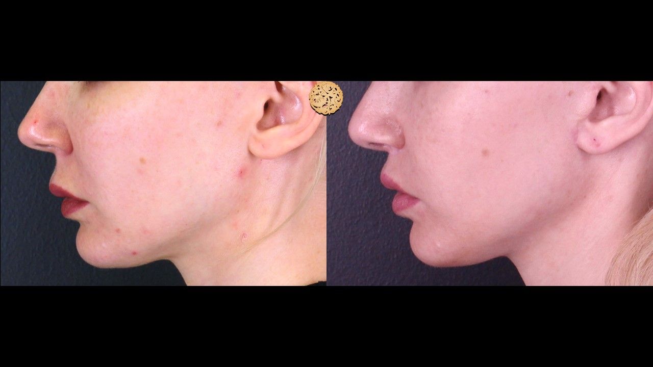 Lip Lift Before & After