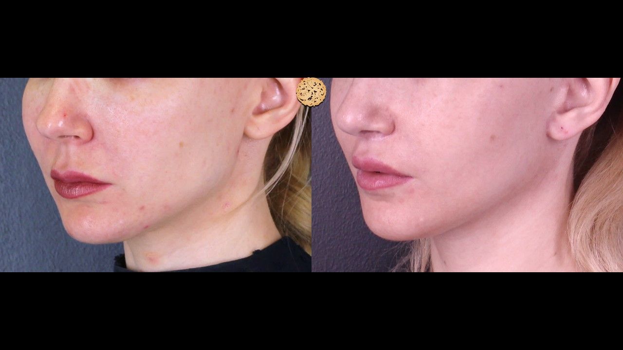 Lip Lift Before & After