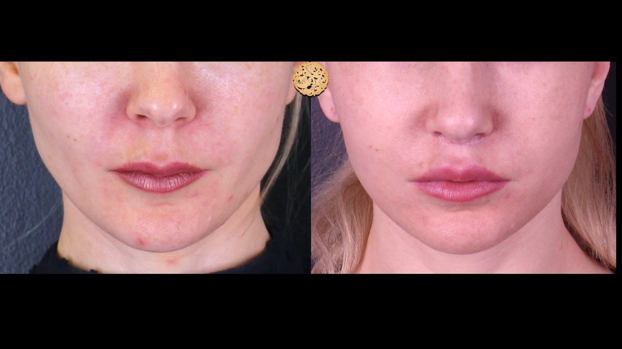 Lip Lift Before & After
