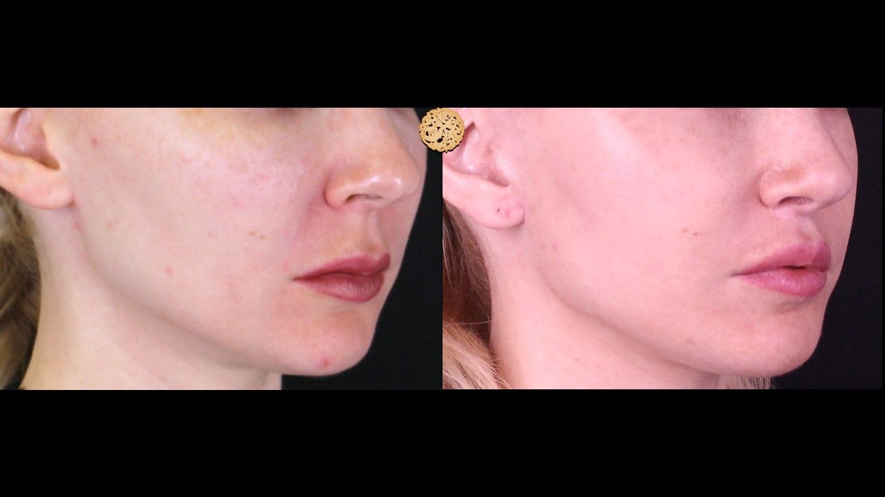 Lip Lift Before & After