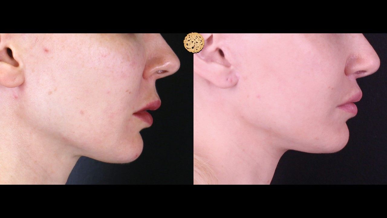 Lip Lift Before & After