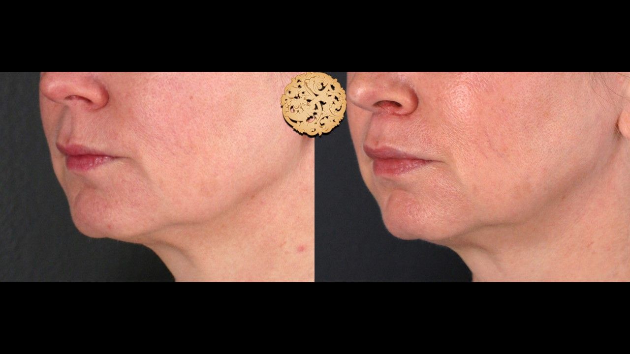 Lip Lift Before & After