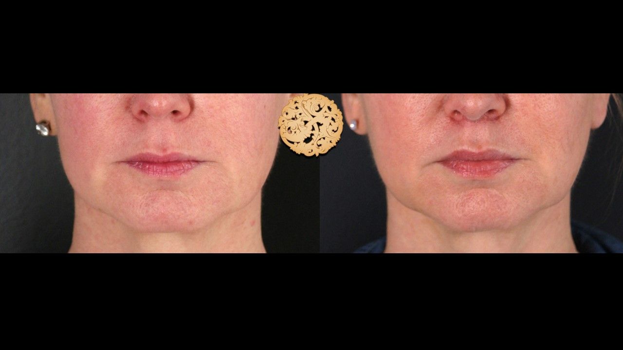 Lip Lift Before & After