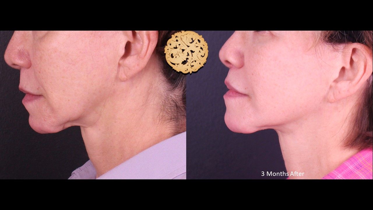 Lip Lift Before & After