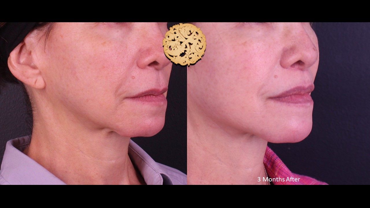 Lip Lift Before & After