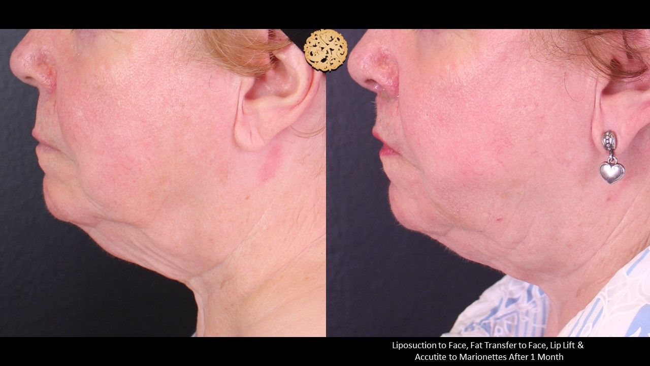 Lip Lift Before & After