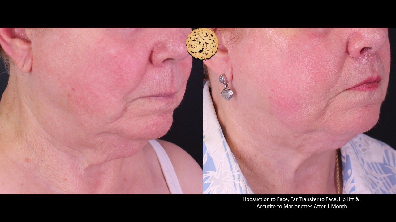 Lip Lift Before & After