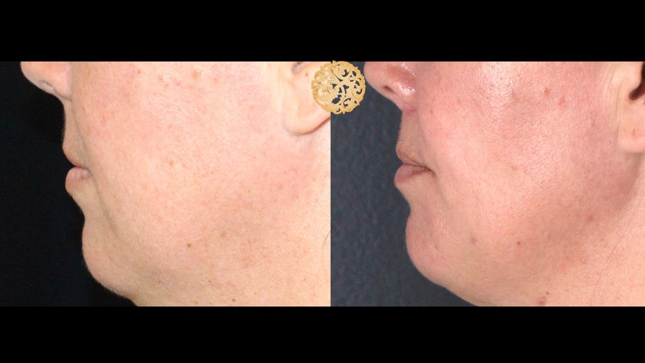 Lip Lift Before & After