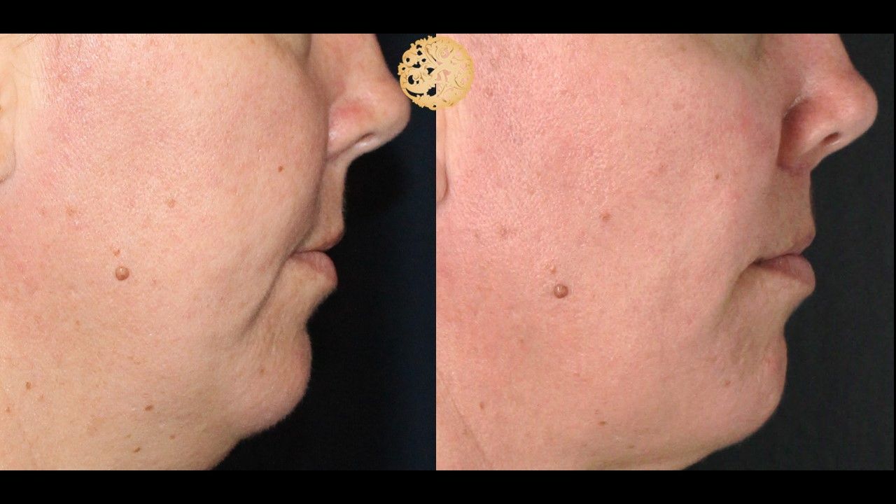 Lip Lift Before & After