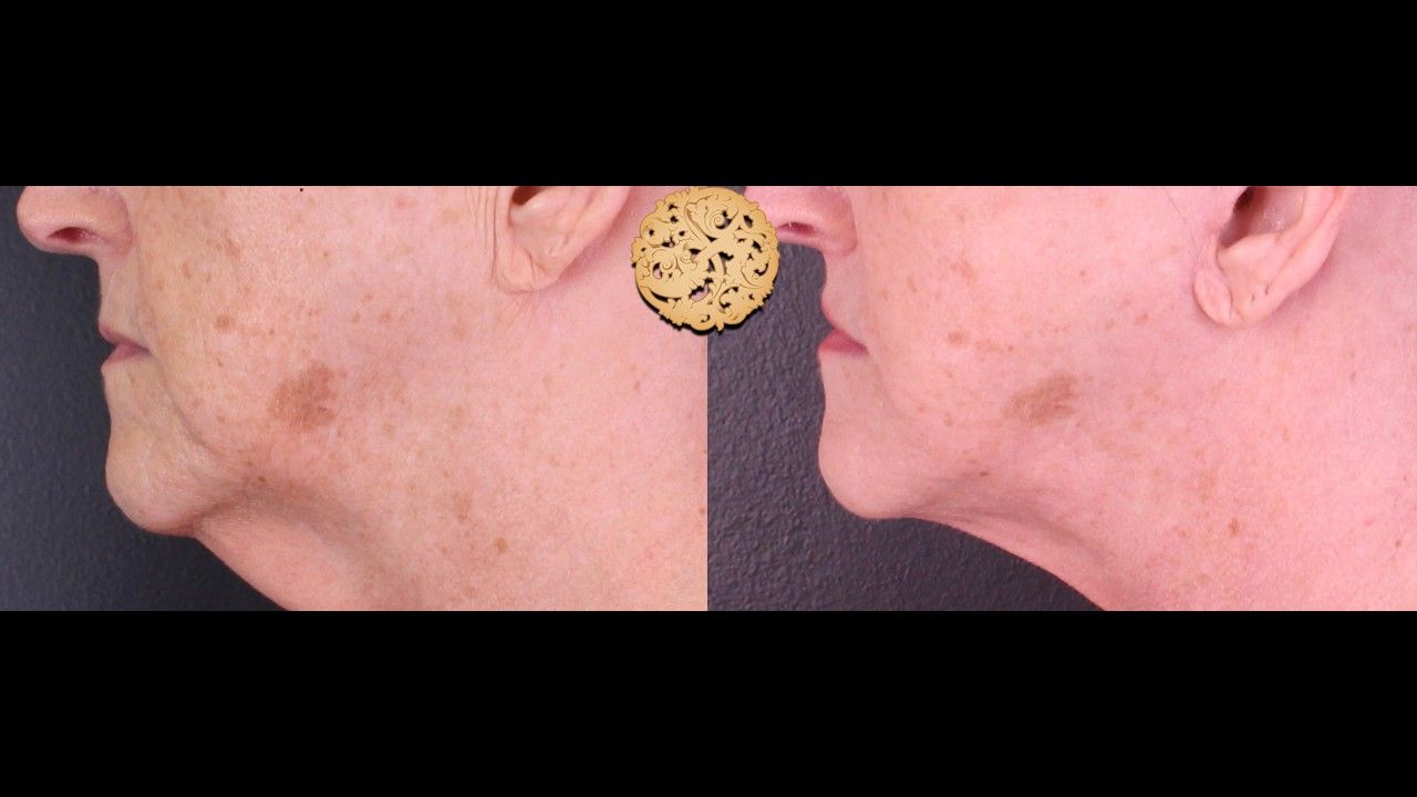 Lip Lift Before & After