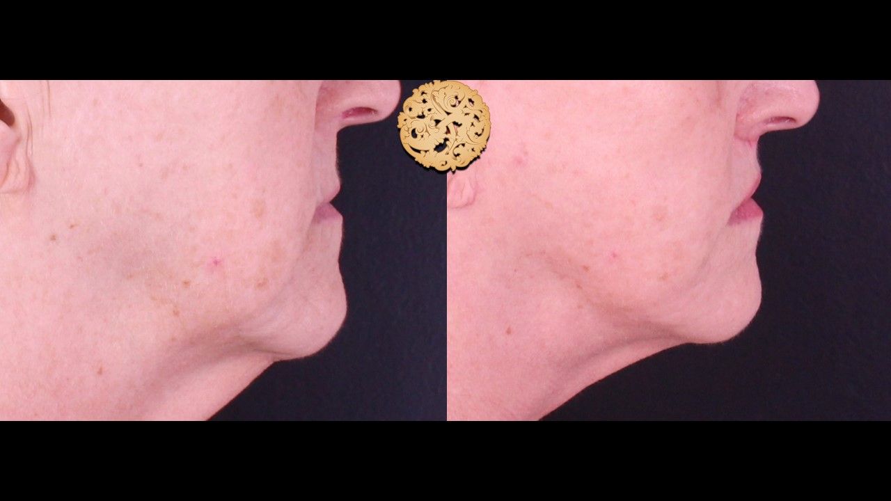 Lip Lift Before & After