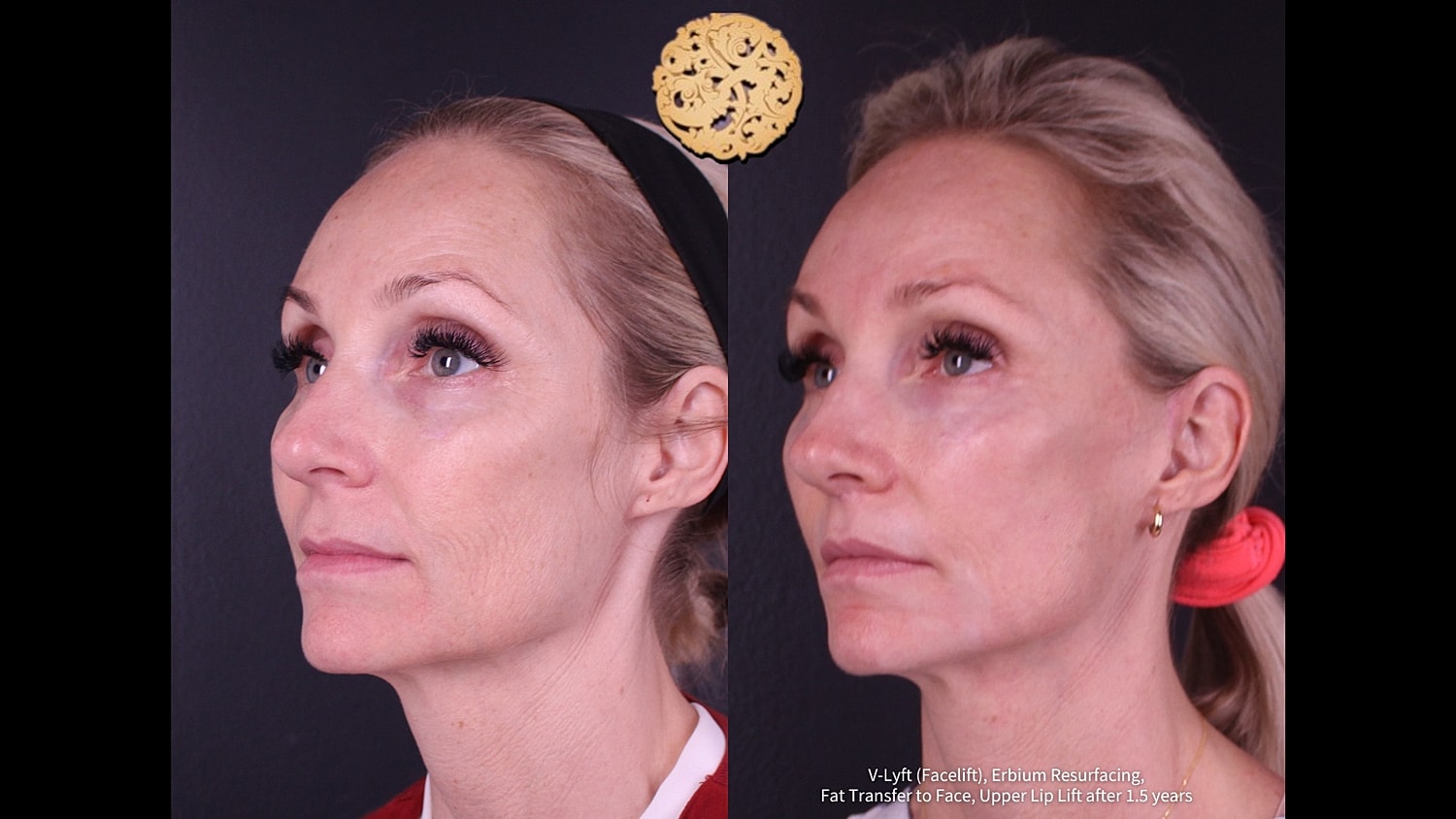 Before and after facial cosmetic procedures comparison.