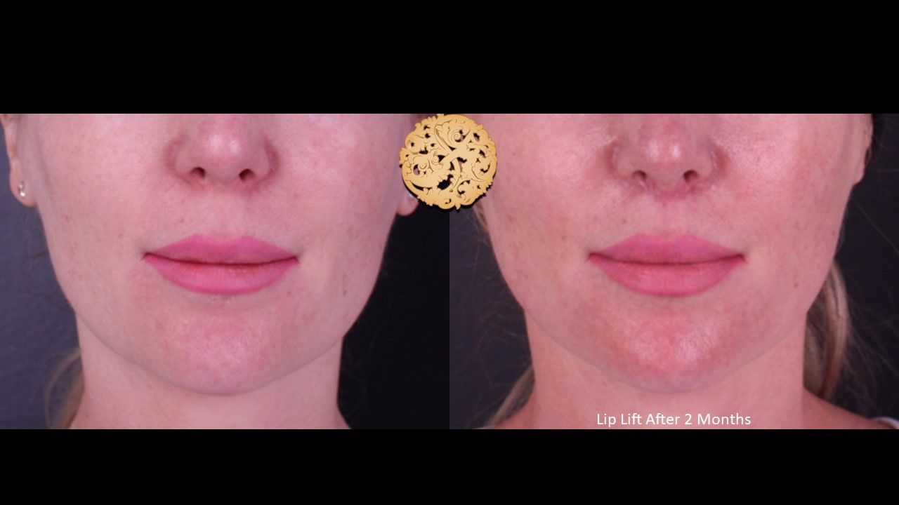 Lip Lift Before & After
