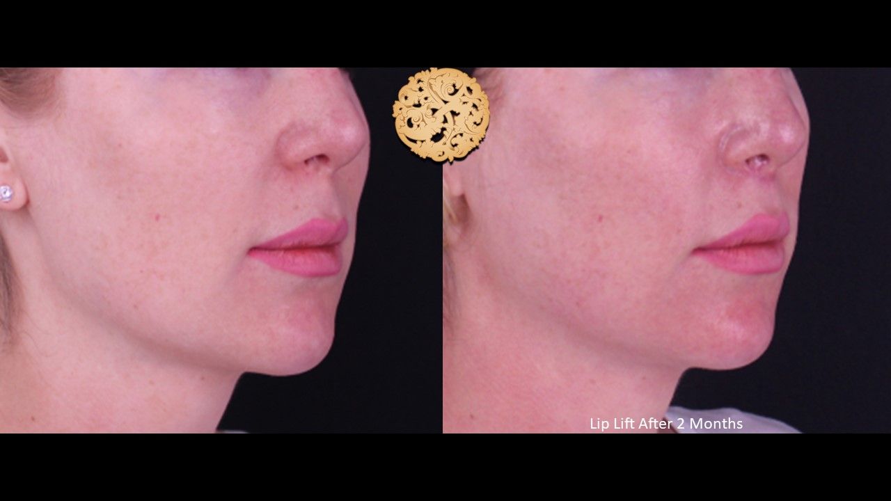 Lip Lift Before & After