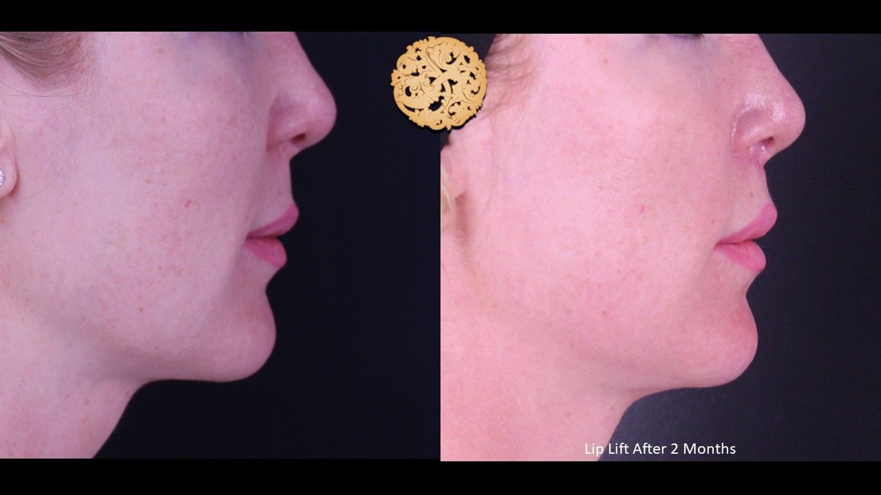 Lip Lift Before & After