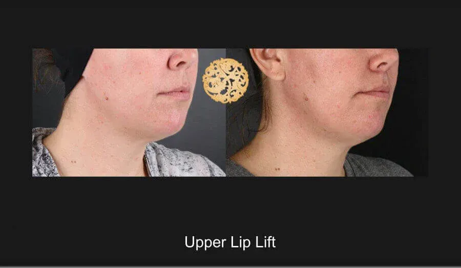 Lip Lift Before & After