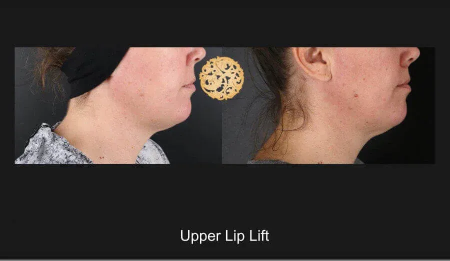 Lip Lift Before & After