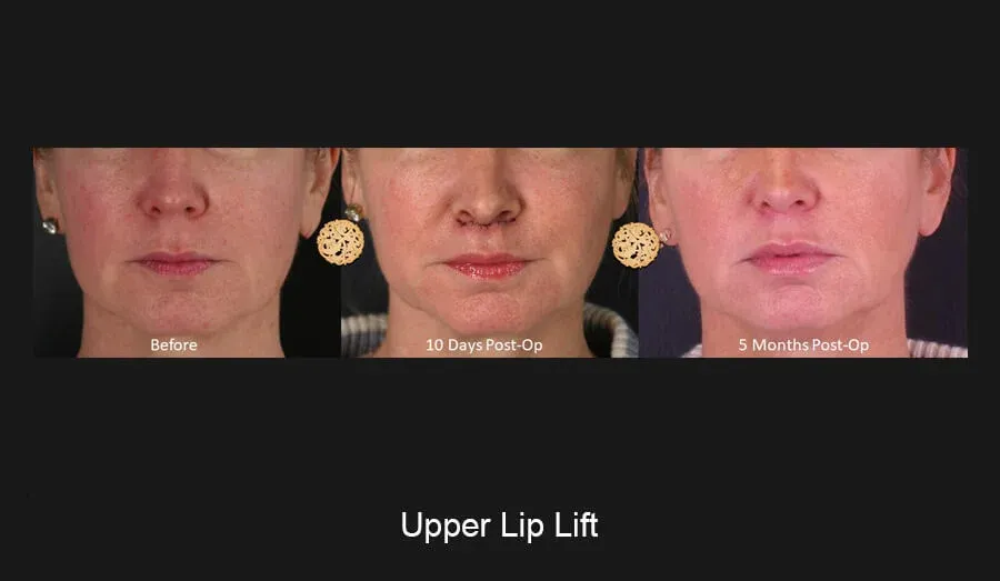 Lip Lift Before & After