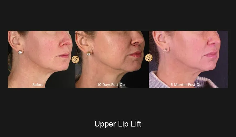 Lip Lift Before & After