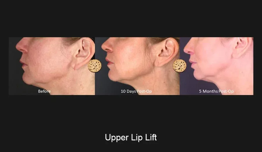 Lip Lift Before & After
