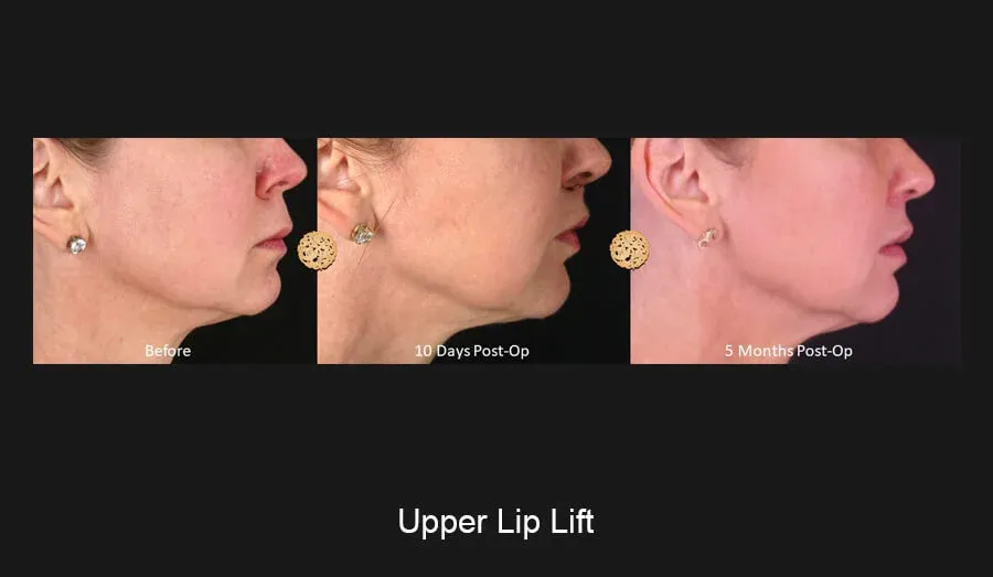 Lip Lift Before & After