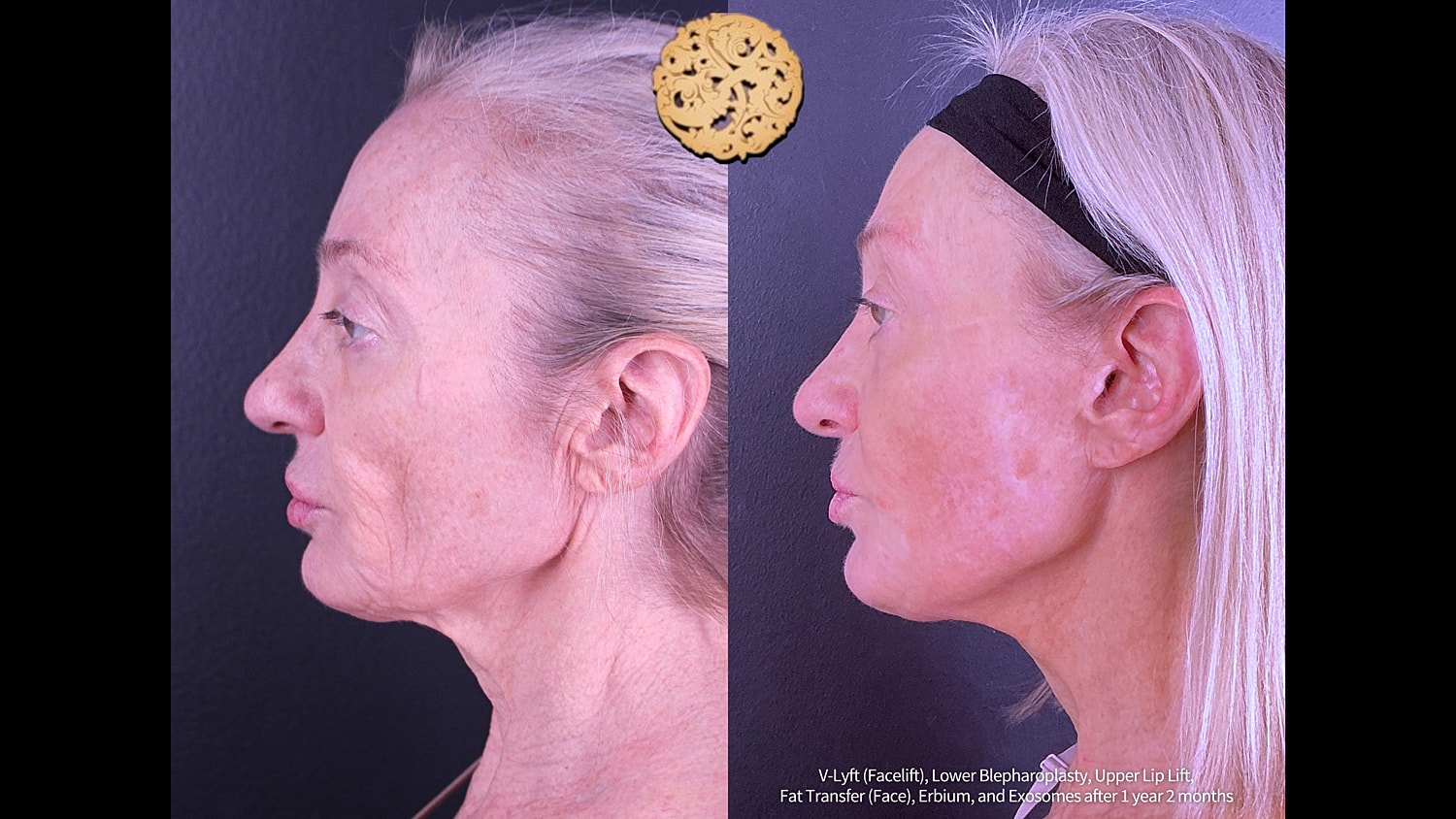 Lip Lift Before & After