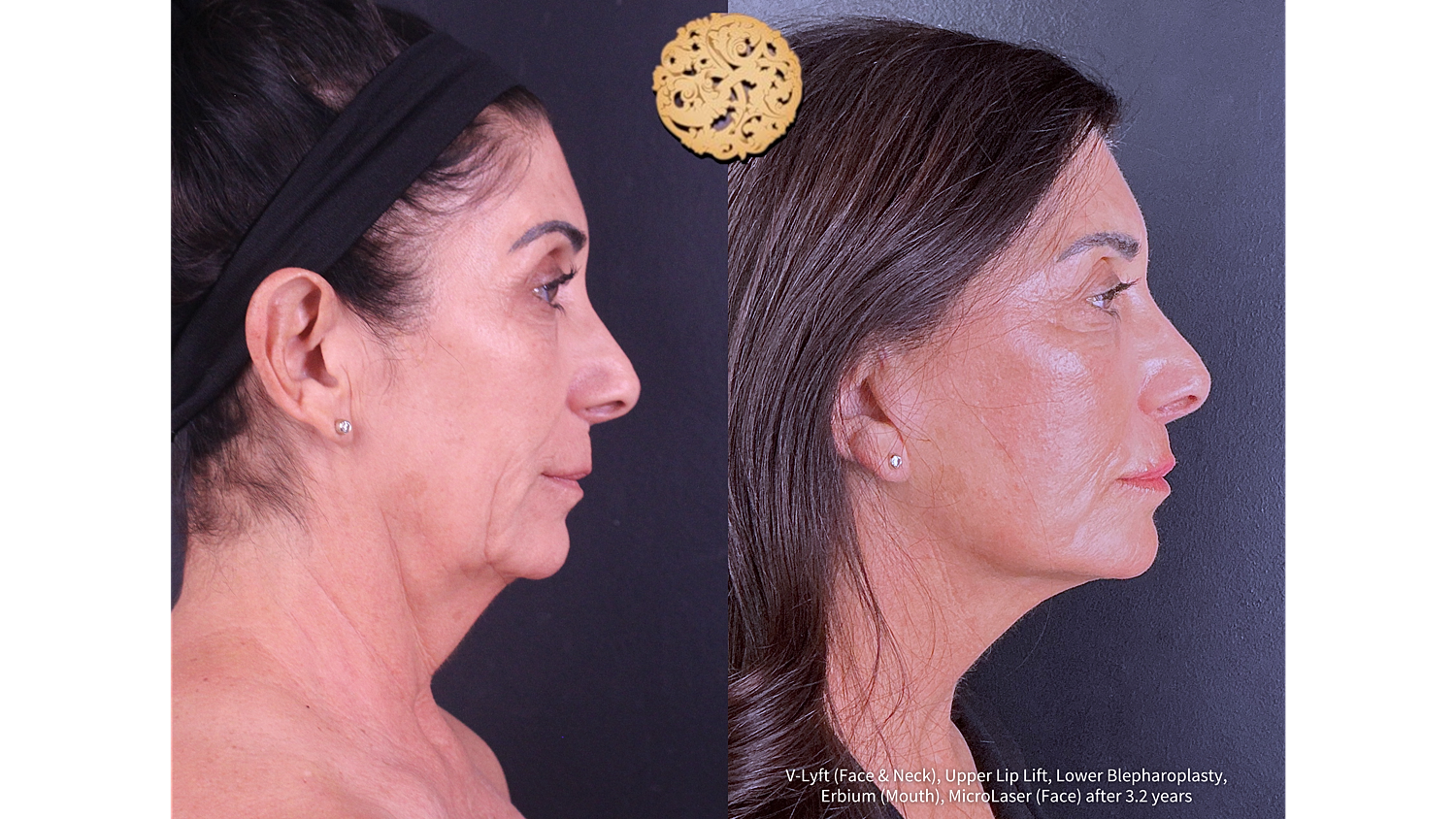 Upper Lip Lift Before and After
