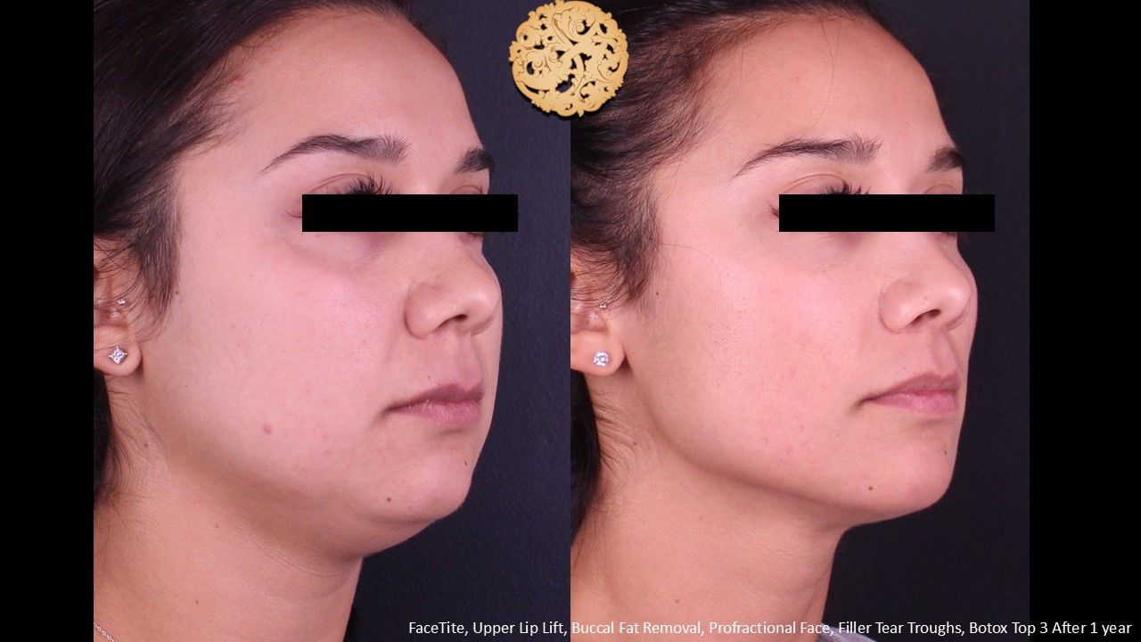 Lip Lift Before & After