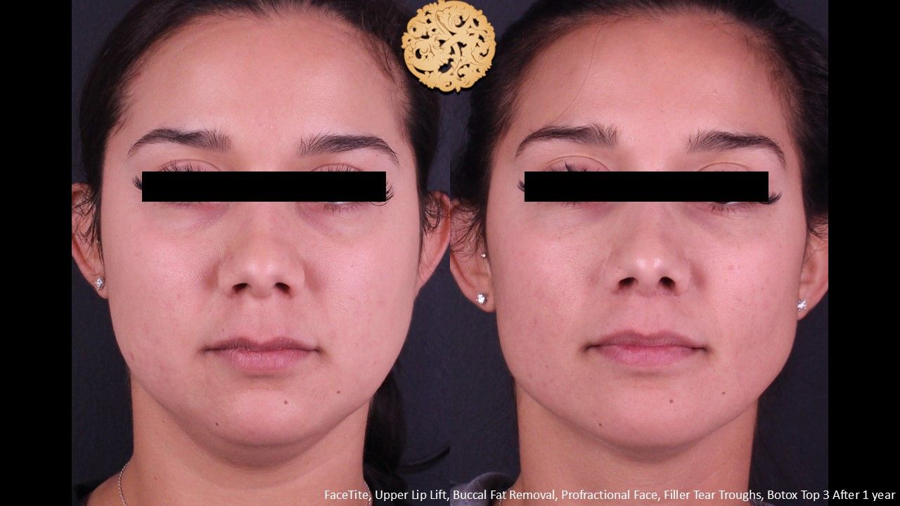 Lip Lift Before & After