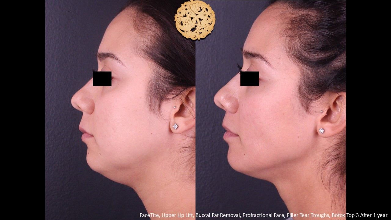 Lip Lift Before & After