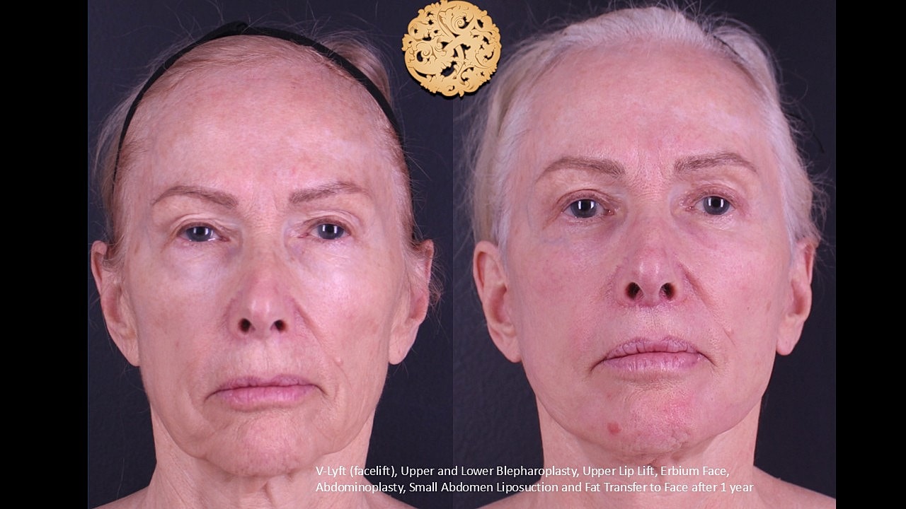 Lip Lift Before & After