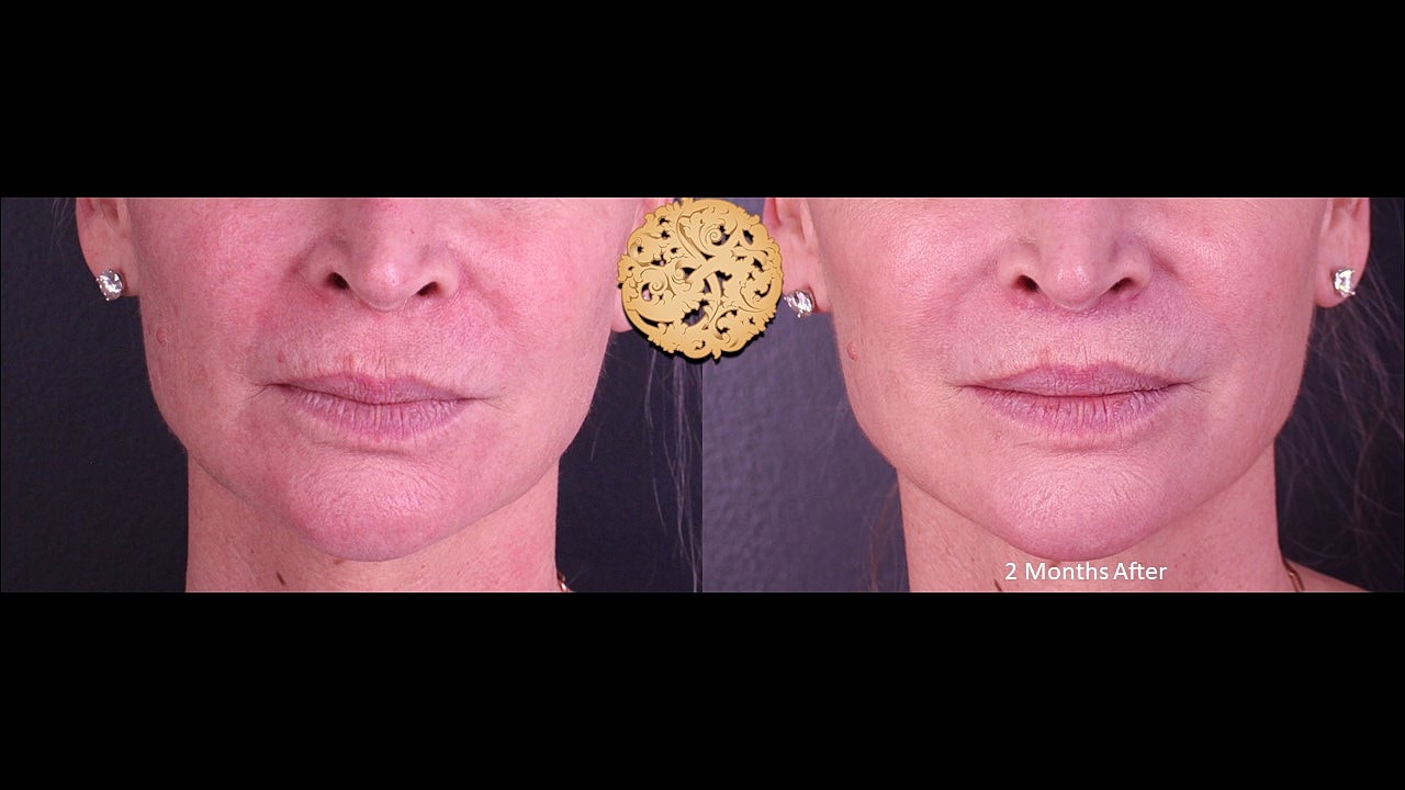 Lip Lift Before & After