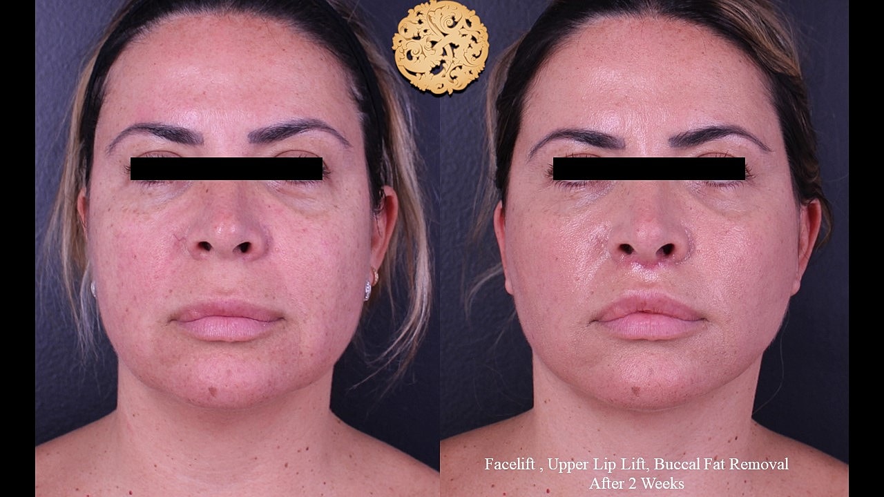Before and after facial cosmetic procedures comparison