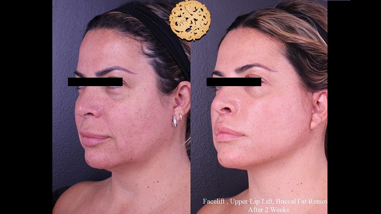 Before and after facial cosmetic procedures comparison
