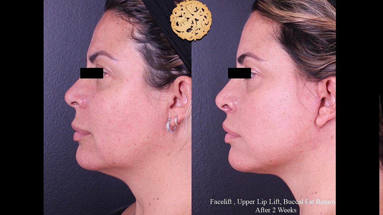Facelift results after two weeks post-surgery.
