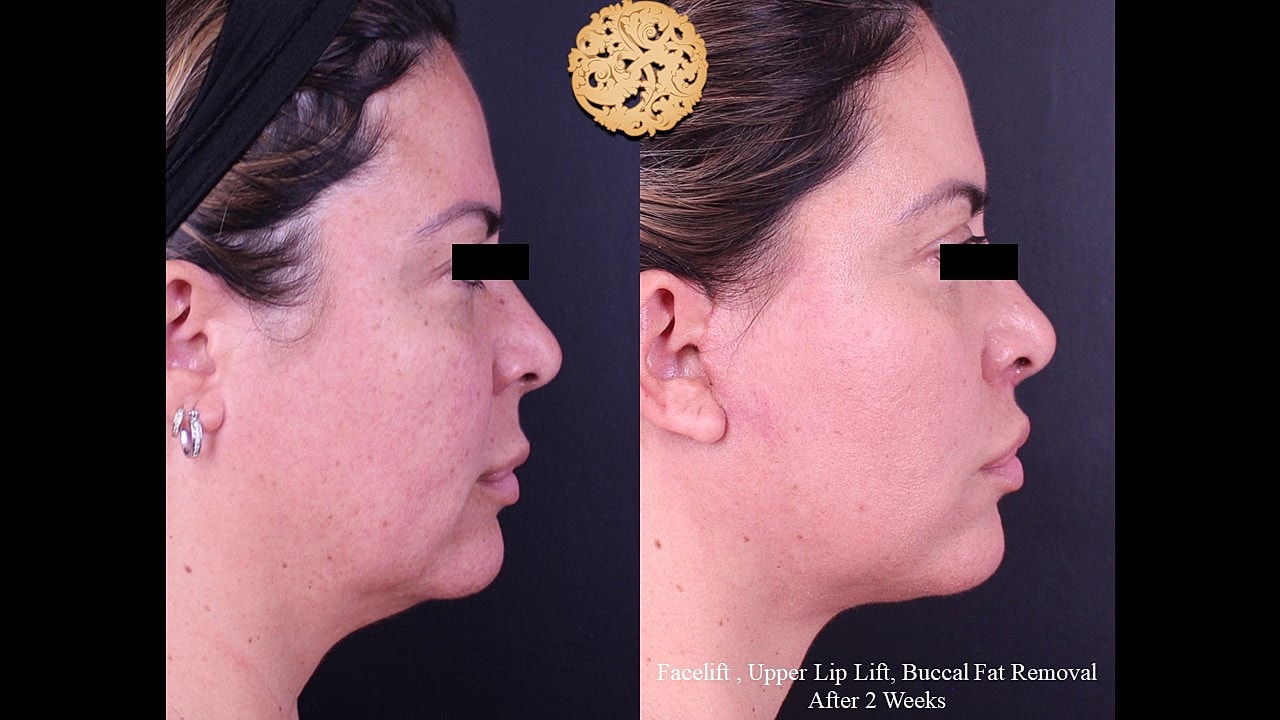 Before and after facial aesthetic treatments comparison.