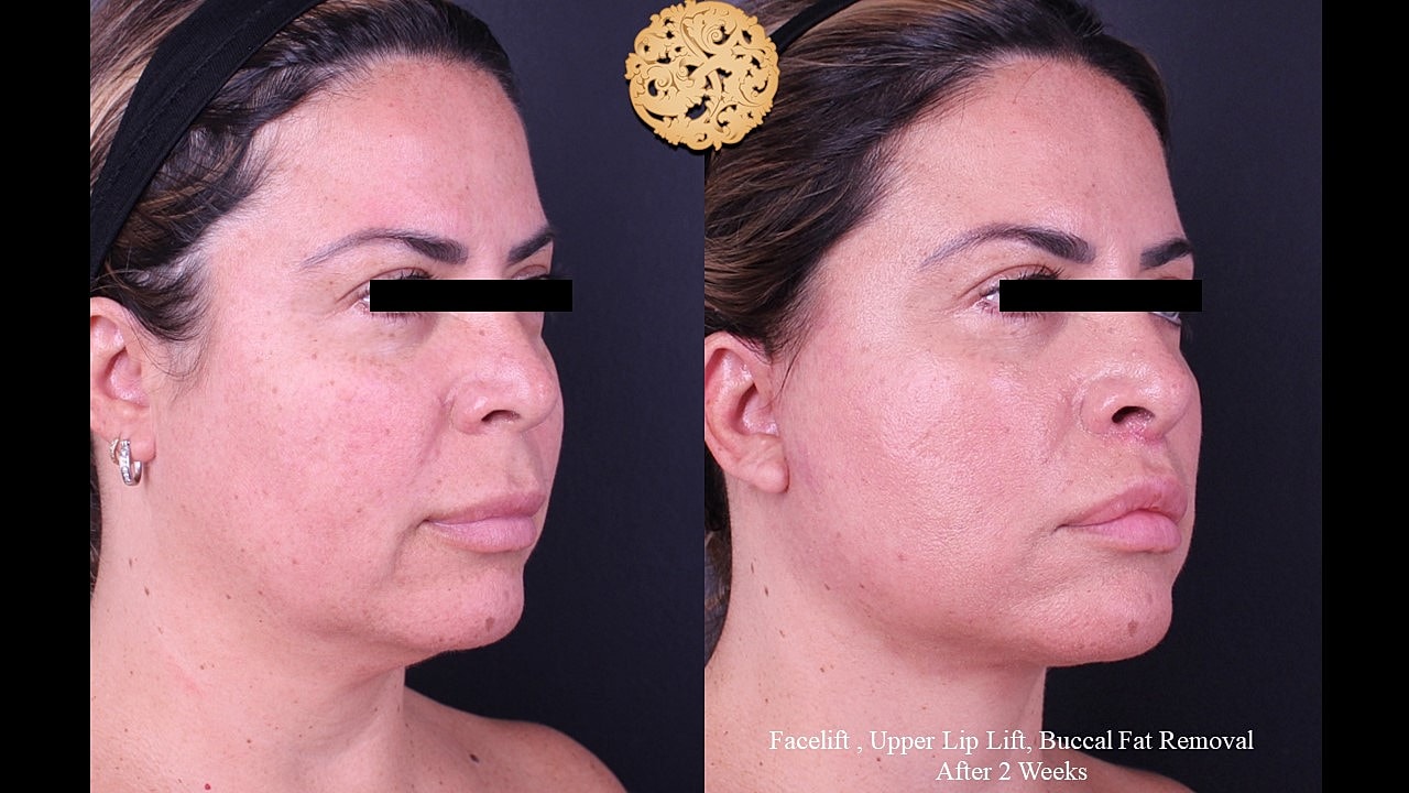 Post-surgery facial transformation, before and after.