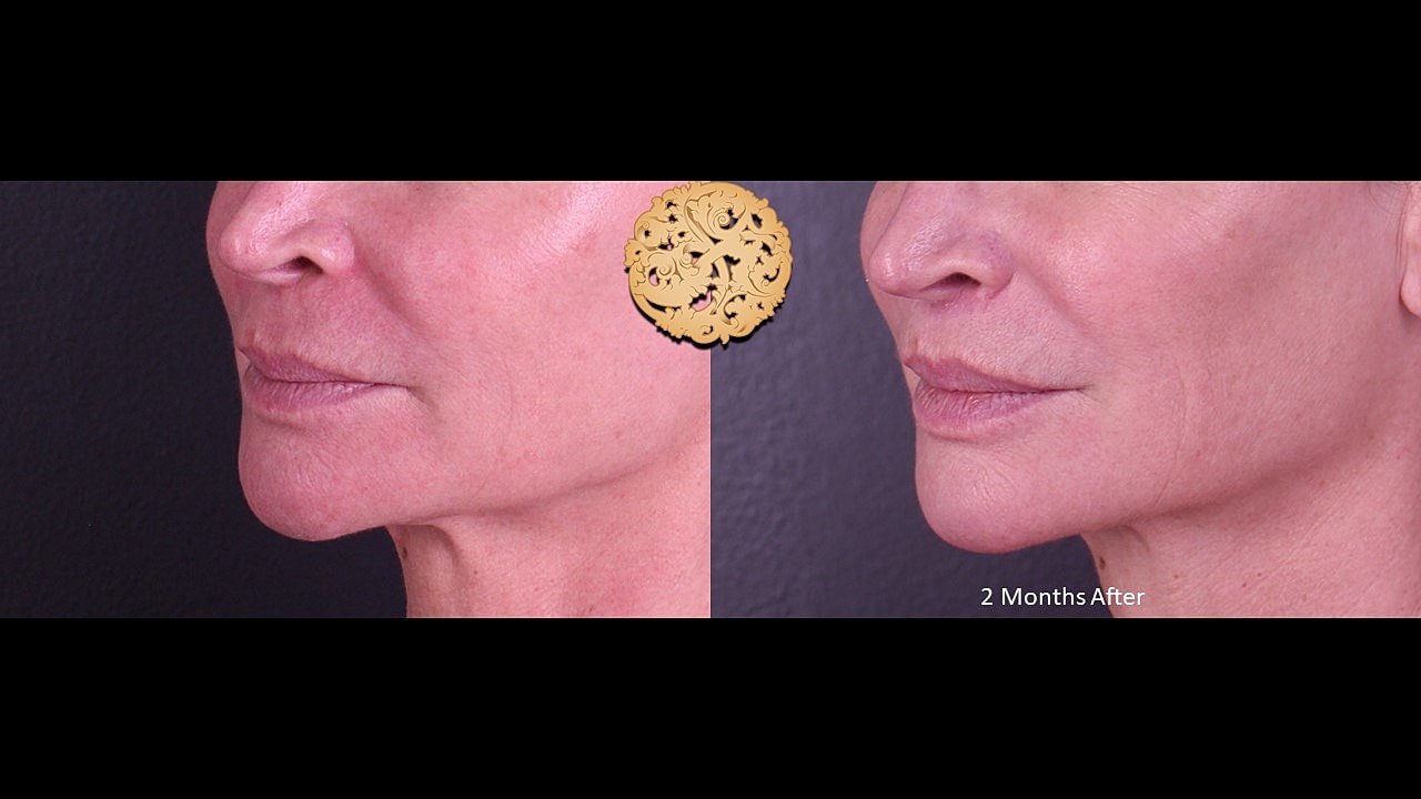 Lip Lift Before & After