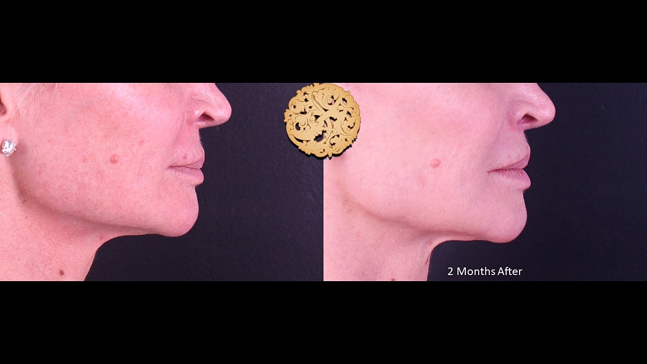 Lip Lift Before & After