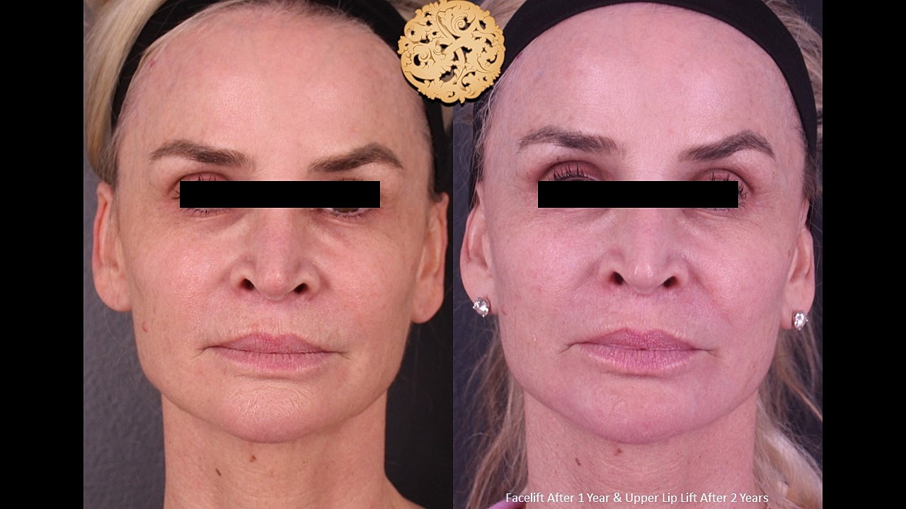 Before and after facelift and lip lift comparison.