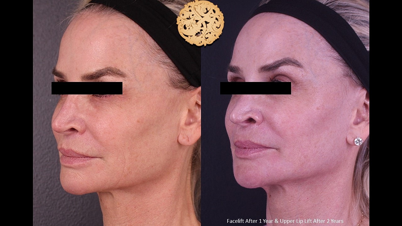 Before and after facelift comparison photos.