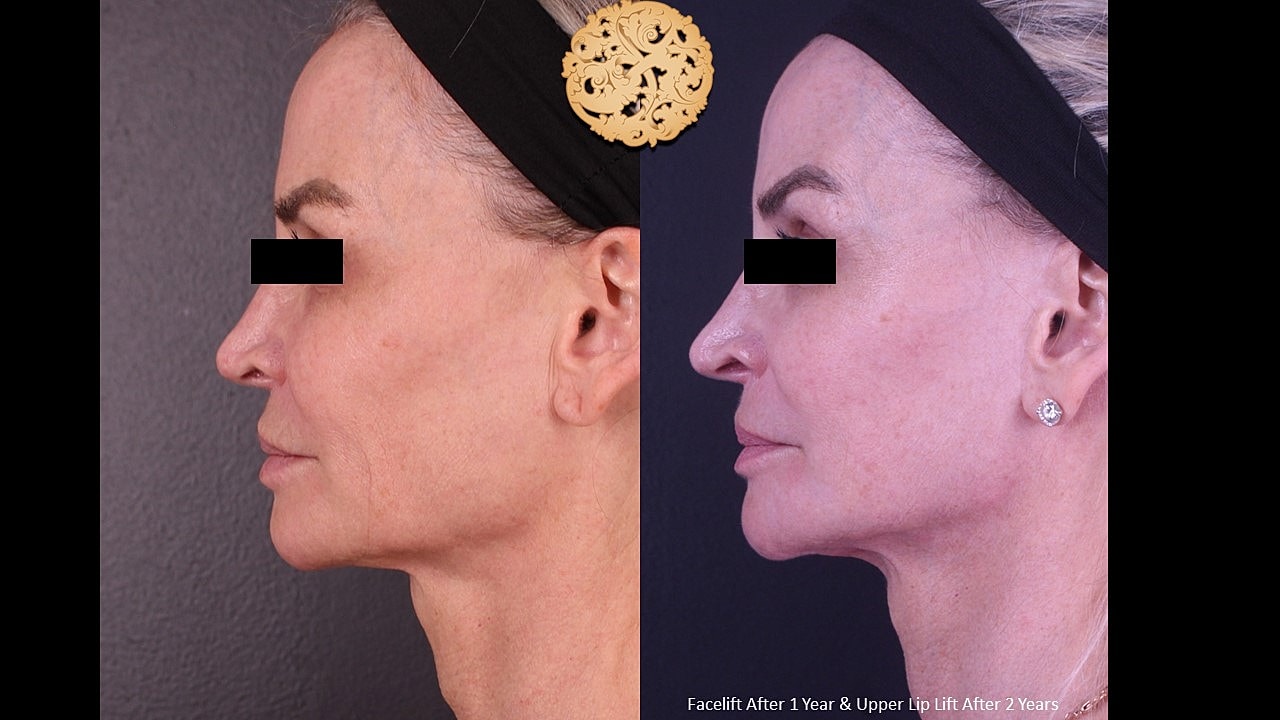 Before and after facelift comparison images.