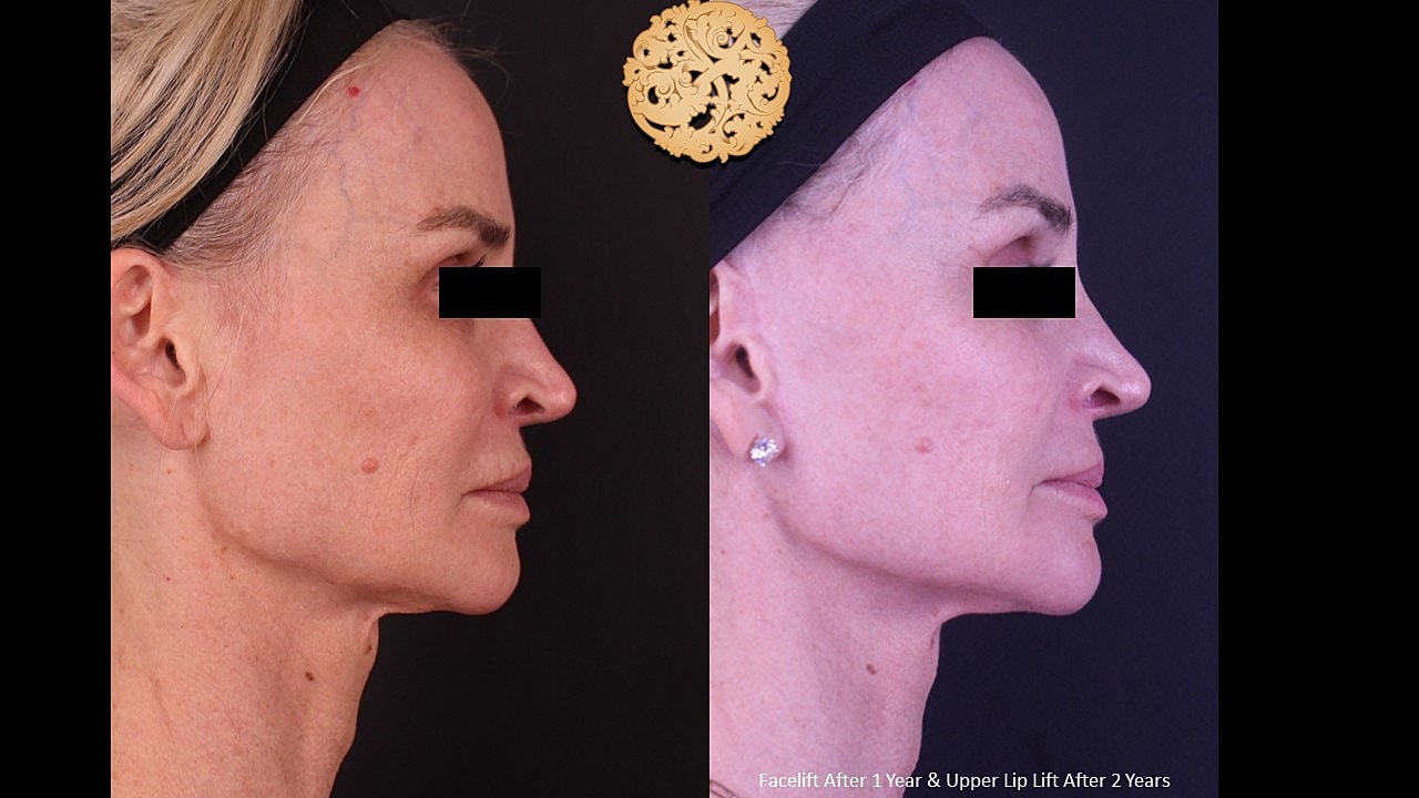 Before and after facelift and lip lift surgery.