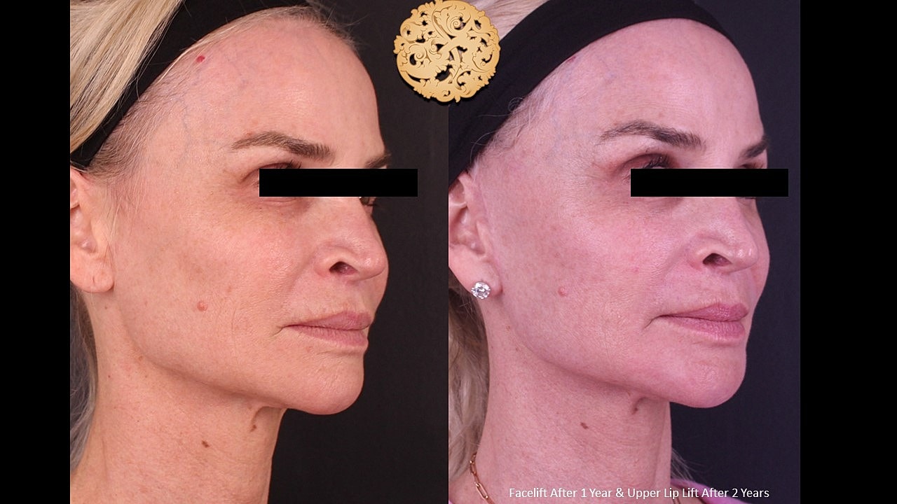 Before and after facelift and lip lift comparison.