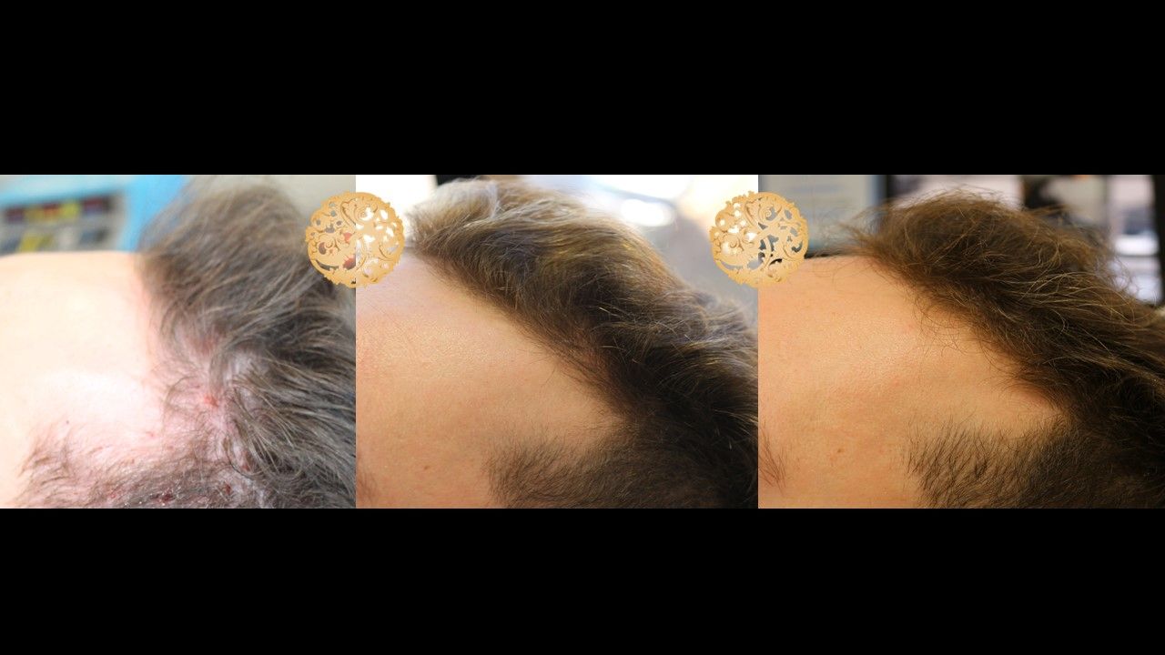 Prp Hair Restoration Before & After