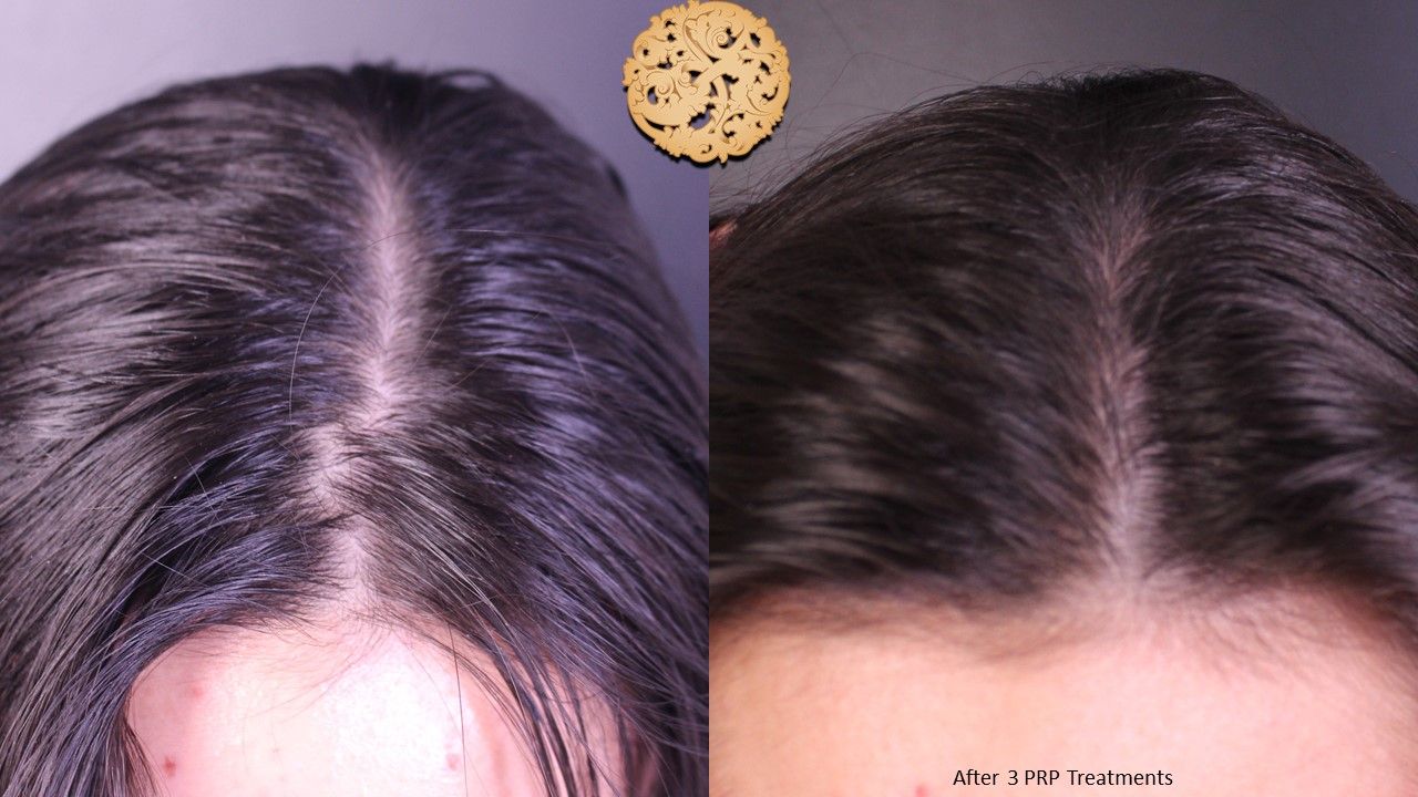 Prp Hair Restoration Before & After